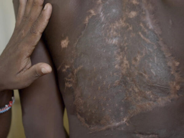 The children suffering from a hidden epidemic