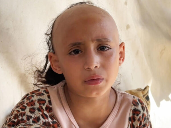 ‘Psychologically broken,’ 8-year-old Sama loses her hair