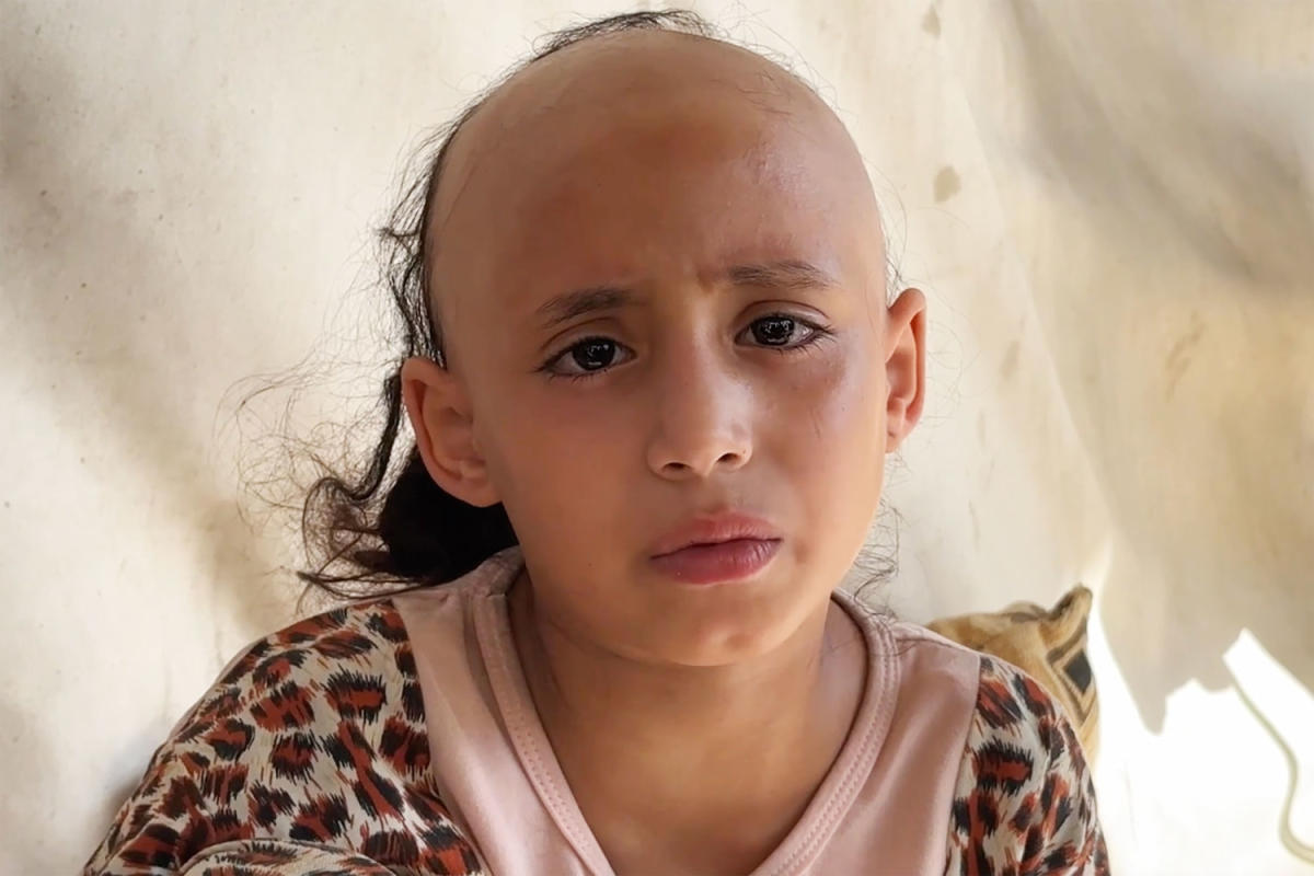 ‘Psychologically broken,’ 8-year-old Sama loses her hair