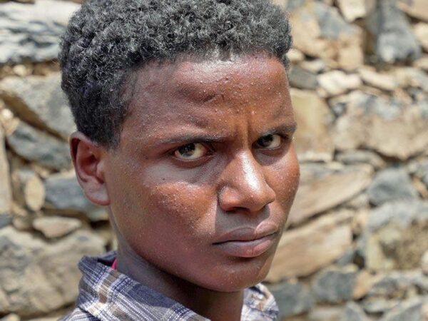 ‘I lost my leg on the way home from school’